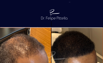 Dr. Felipe Pittella - NW 6 • Afro hair transplant -  Large head, Poor donor, Previous FUT. Take a look at this result.