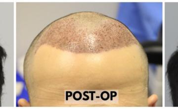 2711 Grafts (5237 Hairs) - FUE Hair Transplant - Dr. Rahal