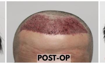 3002 Grafts (6270 Hairs) - FUE Hair Transplant - Dr. Rahal