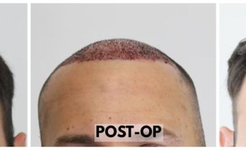 2509 Grafts (5566 Hairs) - FUE Hair Transplant - Dr. Rahal