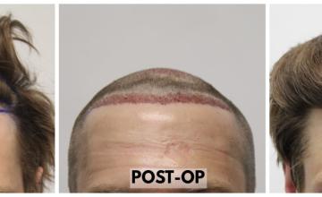 3450 Grafts (7706 Hairs) - FUE Hair Transplant - Dr. Rahal