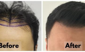 6201 Grafts (13,020 Hairs) - FUE - Dr. Rahal