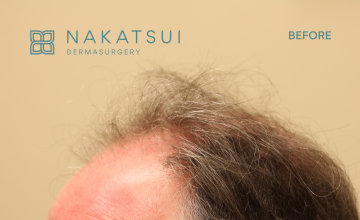 Dr. Nakatsui, frontal and mid scalp