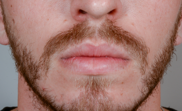 6 month results beard transplant, one session, 926 grafts/1914 hairs FUE- Robert Haber, MD
