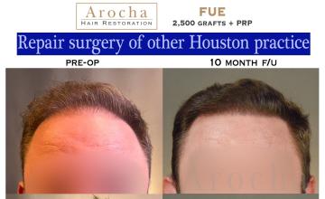 Dr. Arocha | 2500 Graft FUE Repair Case