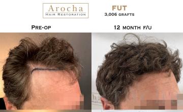 Dr. Arocha | 3006 Graft FUT | 12 month results