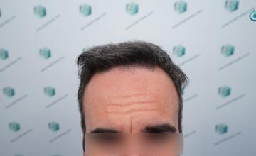 Dr. Rafael de Freitas - 2.005 Grafts - 5.254 Hairs - FUE + DHI