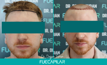 Dr. Turan - FUECAPILAR Clinic, NW II, 1768 grafts