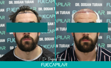 Dr. Turan - FUECAPILAR Clinic, NW III, 2723 grafts