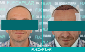 Dr. Turan - FUECAPILAR Clinic, NW Va, 4490 grafts