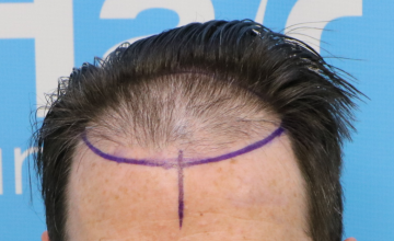 Dr Arshad patient from May 2022. Post op 5 months. The Hair Dr Clinic Leeds (UK).
