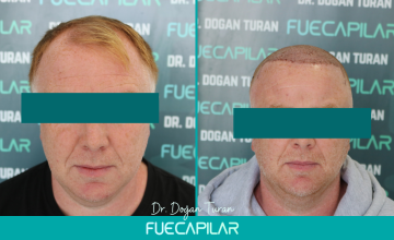 Dr. Turan - FUECAPILAR Clinic, NW IV, 4023 grafts