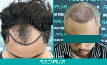 Dr. Turan - FUECAPILAR Clinic, NW IIIa-IVa, 3720 grafts