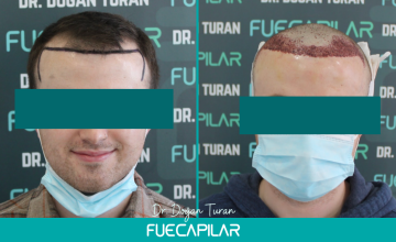 Dr. Turan - FUECAPILAR Clinic, Norwood III, 2606 grafts