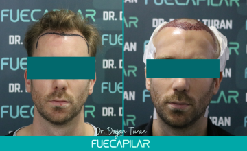 Dr. Turan - FUECAPILAR Clinic, NW III with temple peaks reconstruction, 2738 grafts