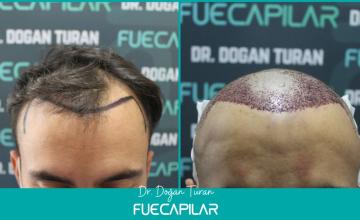 Dr. Turan - FUECAPILAR Clinic, NW III, 2725 grafts