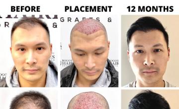 Bogota Hairlines -  2820 Grafts Dr Sergio Camacho (Asian hair type)