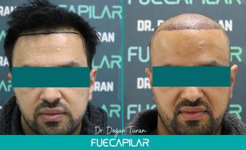 Dr. Turan - FUECAPILAR Clinic, NW IIIv with diffuse thinning in the mid scalp, 3041 grafts