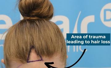 Traumatic alopecia patch in frontal female hairline - Dr Arshad FUE (Hair Dr Clinic, Leeds, UK)