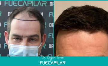 Dr. Turan - FUECAPILAR Clinic, NW IIIa-IVa, 3610 grafts