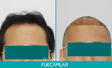 Dr. Gur - FUECAPILAR Clinic, NW IIIv, 2910 grafts