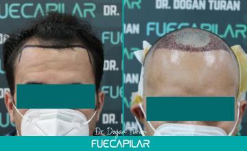 Dr. Turan - FUECAPILAR Clinic, NW IV, 4017 grafts