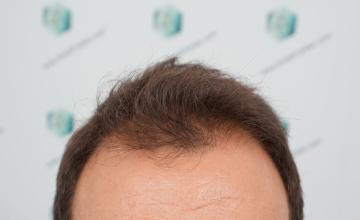 Dr. Rafael de Freitas - 3.418 Grafts - FUE - Clínica de Freitas