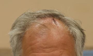 Michael Vories, MD 2500 FUE Grafts