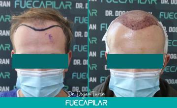 Dr. Turan - FUECAPILAR Clinic, NW IV-V with diffuse thinning, 4287 grafts