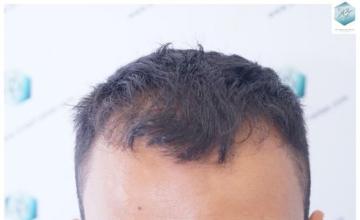 Dr. Rafael de Freitas - 2.120 Grafts - FUE + DHI