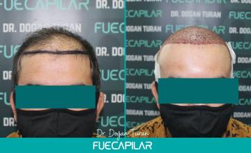 Dr. Turan - FUECAPILAR Clinic, Diffuse thinning NW VI progression, 5136 grafts
