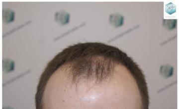 Dr. Rafael de Freitas - 3.124 Grafts - FUE