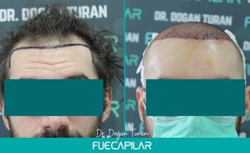 Dr. Turan - FUECAPILAR Clinic, NW IIIv, 3529 grafts