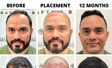 Bogota Hairlines - 2352 Grafts - Dr Sergio Camacho