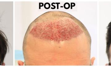 2550 Grafts FUE Hair Transplant with Dr. H. Rahal