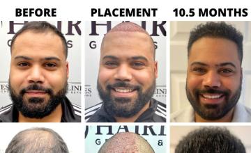 Bogota Hairlines - Dr Sergio Camacho 2406 Grafts (10.5 Months)