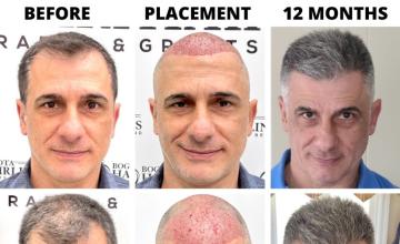 Bogota Hairlines - 2581 Grafts Dr Sergio Camacho
