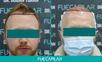 Dr. Turan - FUECAPILAR Clinic, NW III with diffuse thinning in the mid scalp and crown (ginger hair), 3129 grafts