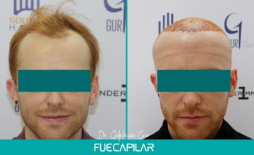 Dr. Gur - FUECAPILAR Clinic, NW IIIv, 3038 grafts