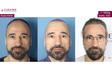 EUGENIX HAIR SCIENCES | MAKE BALDNESS A HISTORY | NW4A | 2 SITTINGS