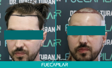 Dr. Turan - FUECAPILAR Clinic, NW III, 2259 grafts