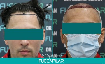Dr. Turan - FUECAPILAR Clinic, NW III, 2338 grafts