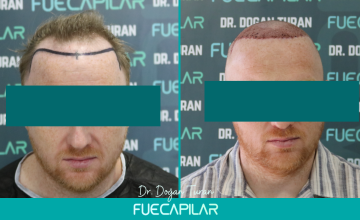 Dr. Turan - FUECAPILAR Clinic, NW IV, 4148 grafts