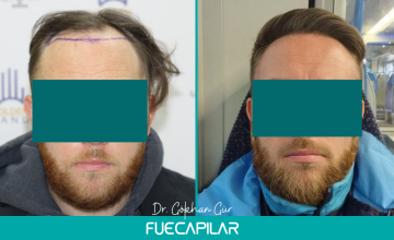 Dr. Gur - FUECAPILAR Clinic, NW IV, 3522 grafts