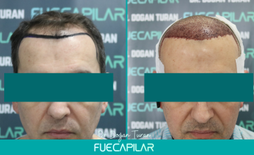 Dr. Turan - FUECAPILAR Clinic, NW III, 2749 grafts