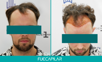 Dr. Gur - FUECAPILAR Clinic, Norwood IIIv-IV, Unshaven - 2867 grafts