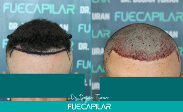 Dr. Turan - FUECAPILAR Clinic, NW II, 2001 grafts