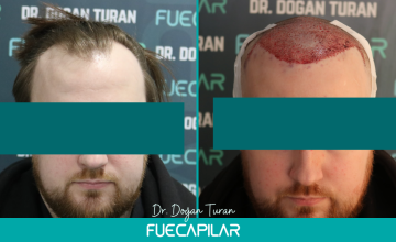 Dr. Turan - FUECAPILAR Clinic, NW III, 2669 grafts