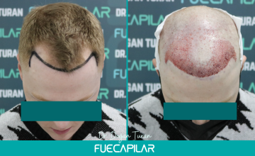 Dr. Turan - FUECAPILAR Clinic, NW III, 2888 grafts