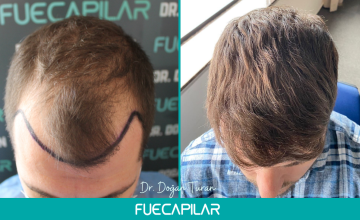 Dr. Turan - FUECAPILAR Clinic, NW III + diffuse thinning in the mid scalp and upper vertex, 3648 grafts